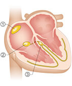 Das Erregungs-Leitungssystem des Herzens organisiert den normalen Herzryhthmus (1 Sinusknoten, 2 AV-Knoten, 3 His-Bündel und Purkinje-Fasern)