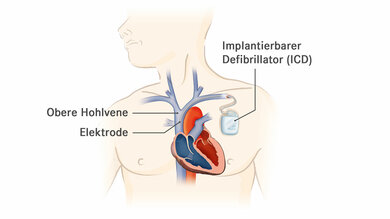 Ein implantierbarer Defibrillator (ICD) erkennt ein Kammerflimmern und unterbricht es durch einen Elektroschock