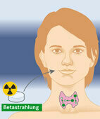 Das radioaktive Iod wirkt direkt in der Schilddrüse