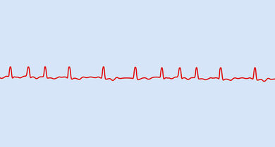 EKG-Kurve bei Vorhofflimmern