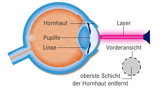 Infografik Augen lasern 1