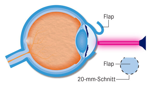 Infografik Augen lasern 2