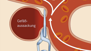 Wie Arzte Ein Gehirn Aneurysma Behandeln Apotheken Umschau