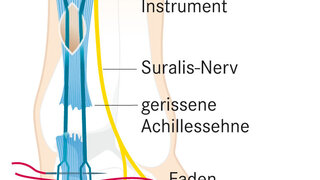 Wie Ein Achillessehnenriss Am Besten Heilt Apotheken Umschau