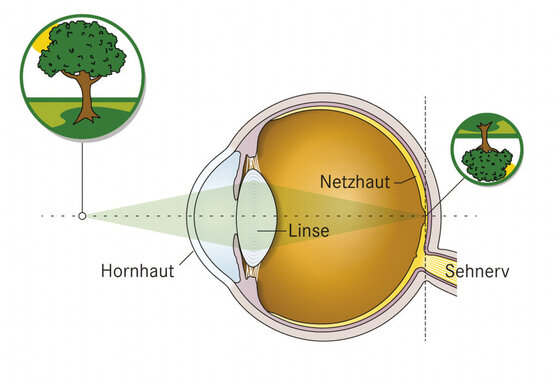 Kurzsichtigkeit Auf Dem Vormarsch Apotheken Umschau