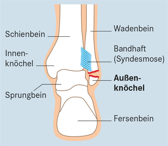 Sprunggelenkbruch Sprunggelenksfraktur Apotheken Umschau