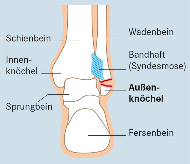 Knöchelbruch: Weber-Fraktur A