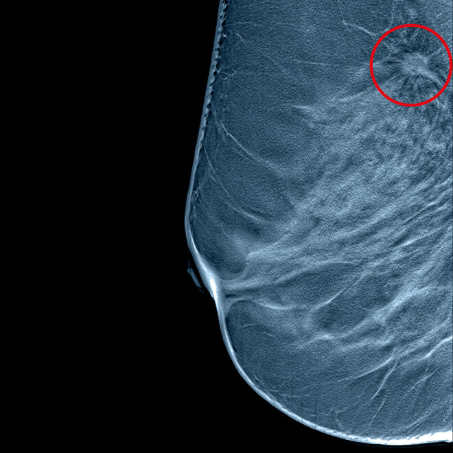 S/W Tomographie einer Brust mit Tumor 