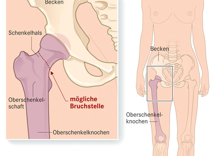 Oberschenkelhalsbruch Schenkelhalsfraktur Apotheken Umschau