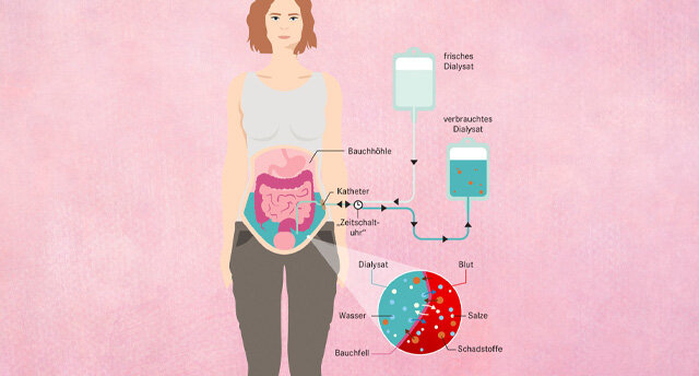 Infografik Dialyse