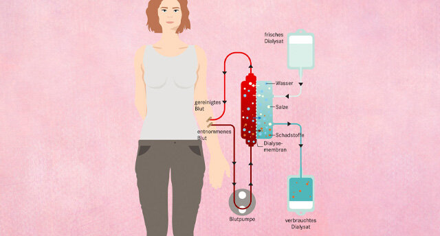 Infografik Dialyse