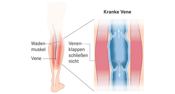 Kompressionsstrumpfe Einmal Trifft Es Jeden Apotheken Umschau