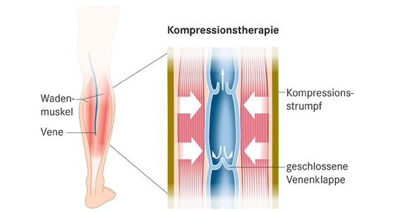 Kompressionsstrumpfe Einmal Trifft Es Jeden Apotheken Umschau