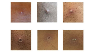 Auf diesem Bild sind die Hautveränderungen bei infizierten Mpox-Patienten zu sehen.