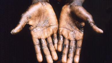 Dieses Bild aus dem Jahr 1997 entstand während einer Untersuchung eines Affenpockenausbruchs in der Demokratischen Republik Kongo, und zeigt die Handflächen eines Affenpockenpatienten.