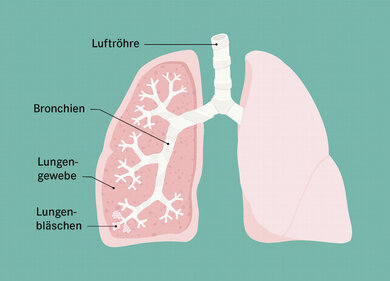 Die Bronchien verbinden die Luftröhre mit der Lunge. Am Ende der Bronchien sind die Lungenbläschen. Zwischen den Lungenbläschen ist das Lungengewebe.
