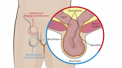 Das Bild zeigt: Bei einem Leistenbruch rutschen Teile vom Bauchfell oder Teile vom Darm in die Lücke zwischen den Muskeln.