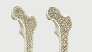 Das Bild zeigt: Auf der linken Seite ist ein gesunder Knochen. Auf der rechten Seite ist ein Knochen mit Osteoporose. Bei einer Osteoporose sind die Hohlräume im Knochen größer.