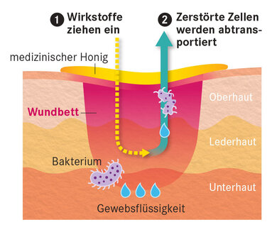 Honig entzieht der Wunde Wasser. Er besteht zu 80 Prozent aus Zucker und zu 20 Prozent aus Wasser. Eine Wunde dagegen enthält viel Flüssigkeit. Um den Konzentrationsunterschied auszugleichen, wird der Wunde und den darin befindlichen Bakterien Wasser entzogen