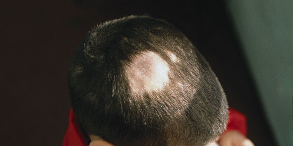Причины выпадения волос у подростка